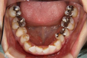 臼歯部はほとんどが補綴されています